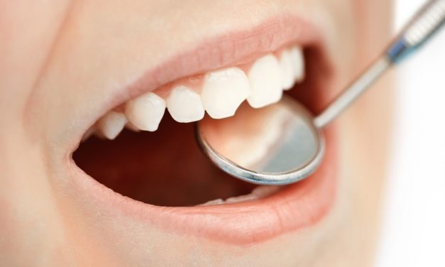 Sigilarea dinților – cea mai bună metodă de prevenire a cariilor dentare