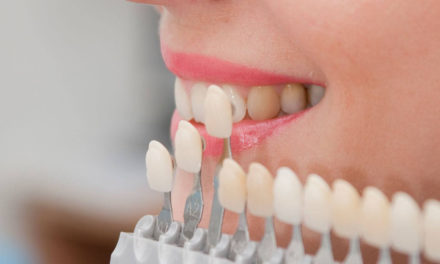 3 intrebari si raspunsuri despre fatete dentare
