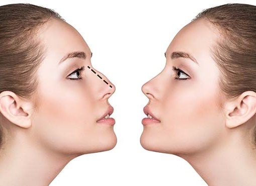 Rinoplastia – o interventie chirurgicala  cu multiple beneficii