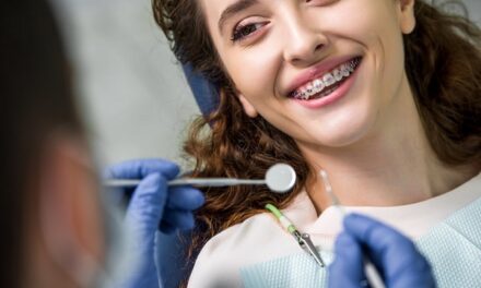 Ce trebuie sa stii despre albirea dentara dupa indepartarea aparatului dentar