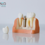 Implantologie dentară: când e momentul să-ți faci implant dentar all on 4 la clinica ISMED