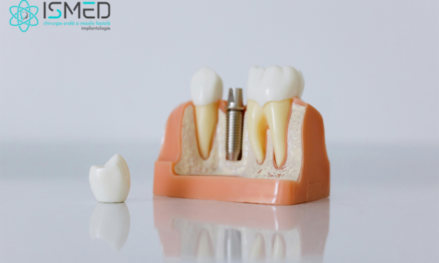 Implantologie dentară: când e momentul să-ți faci implant dentar all on 4 la clinica ISMED