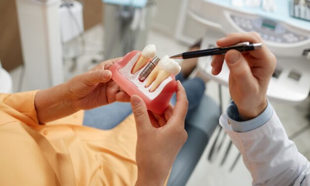 Ce factori influențează prețul unui implant dentar: La ce să fii atent?